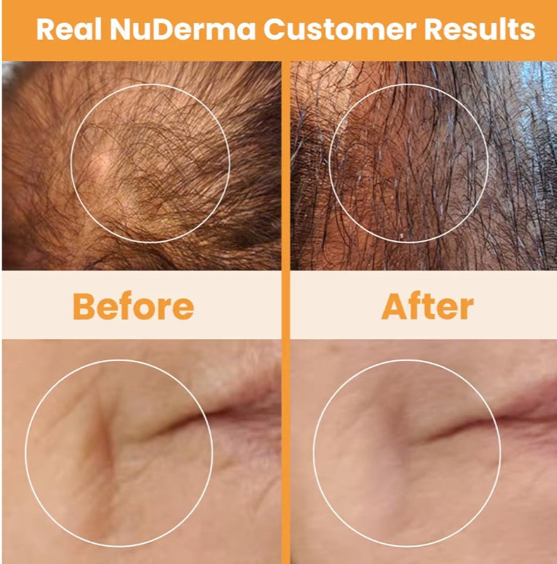 Pure Daily Care NuDerma Handheld Skin Therapy Wand Machine w/Neon – Anti-Aging - Skin Tightening - Wrinkle Reducing - Dark Circles – Clarifying - Hair & Scalp Stimulator